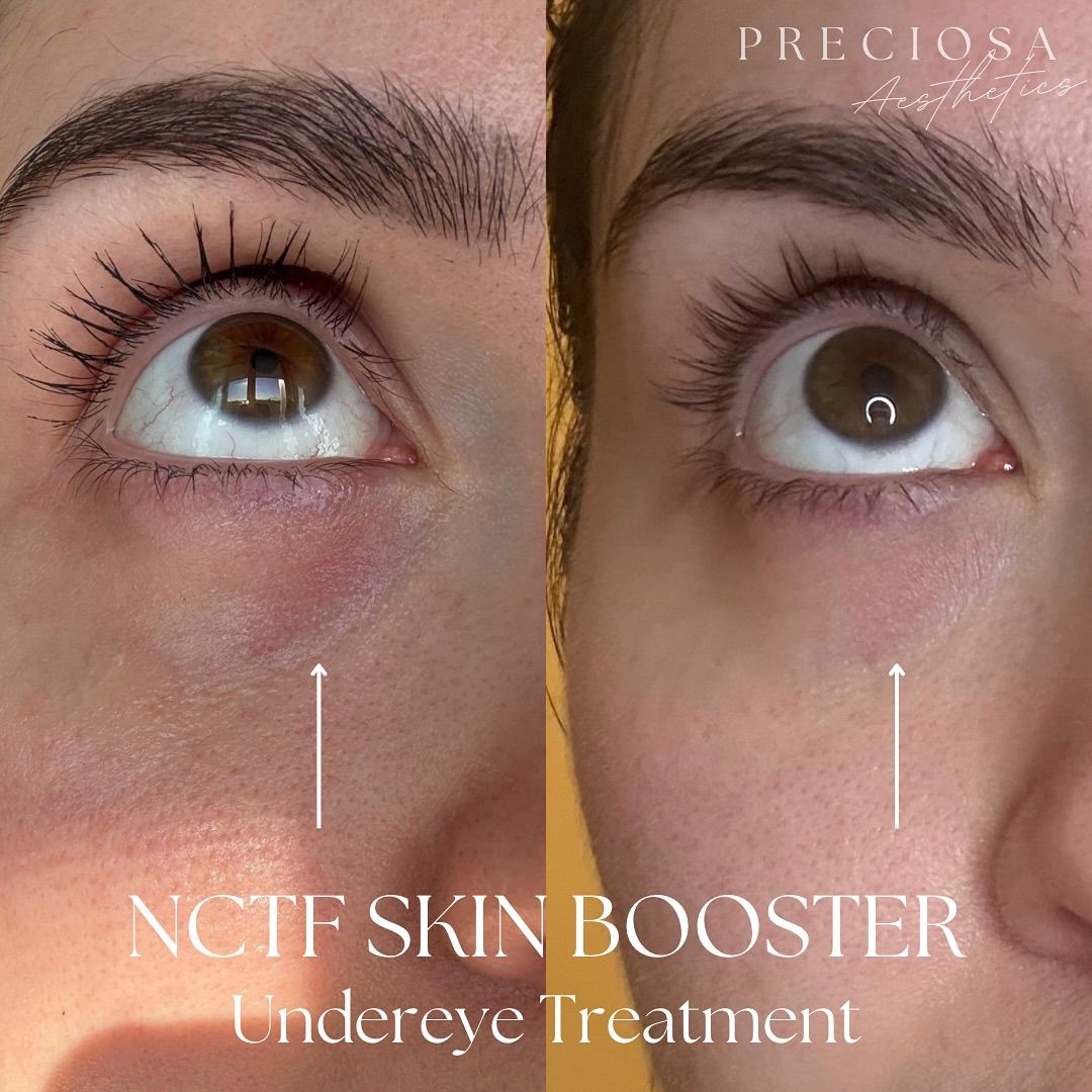 Before & After — NCTF & Quench