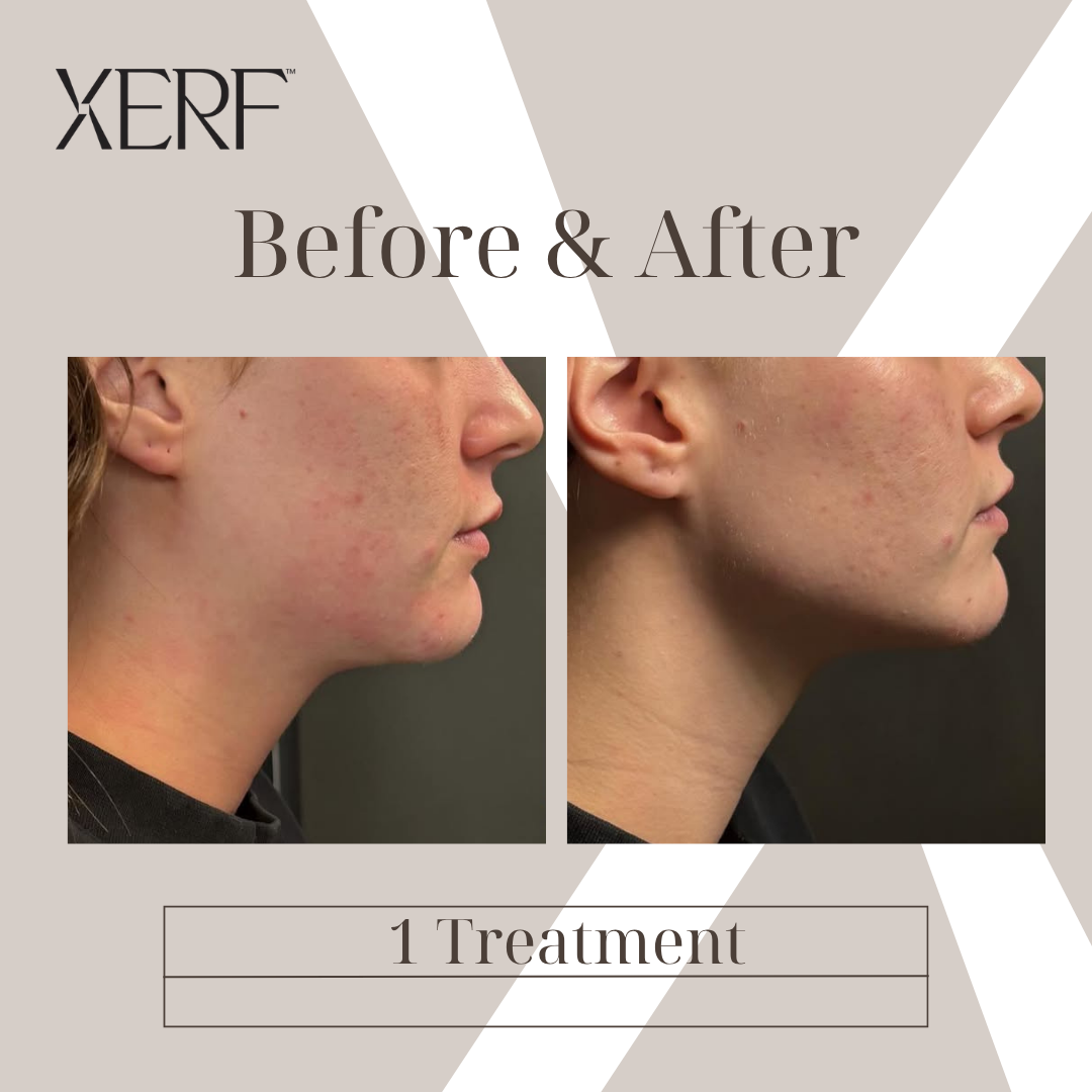 Before & After — XERF