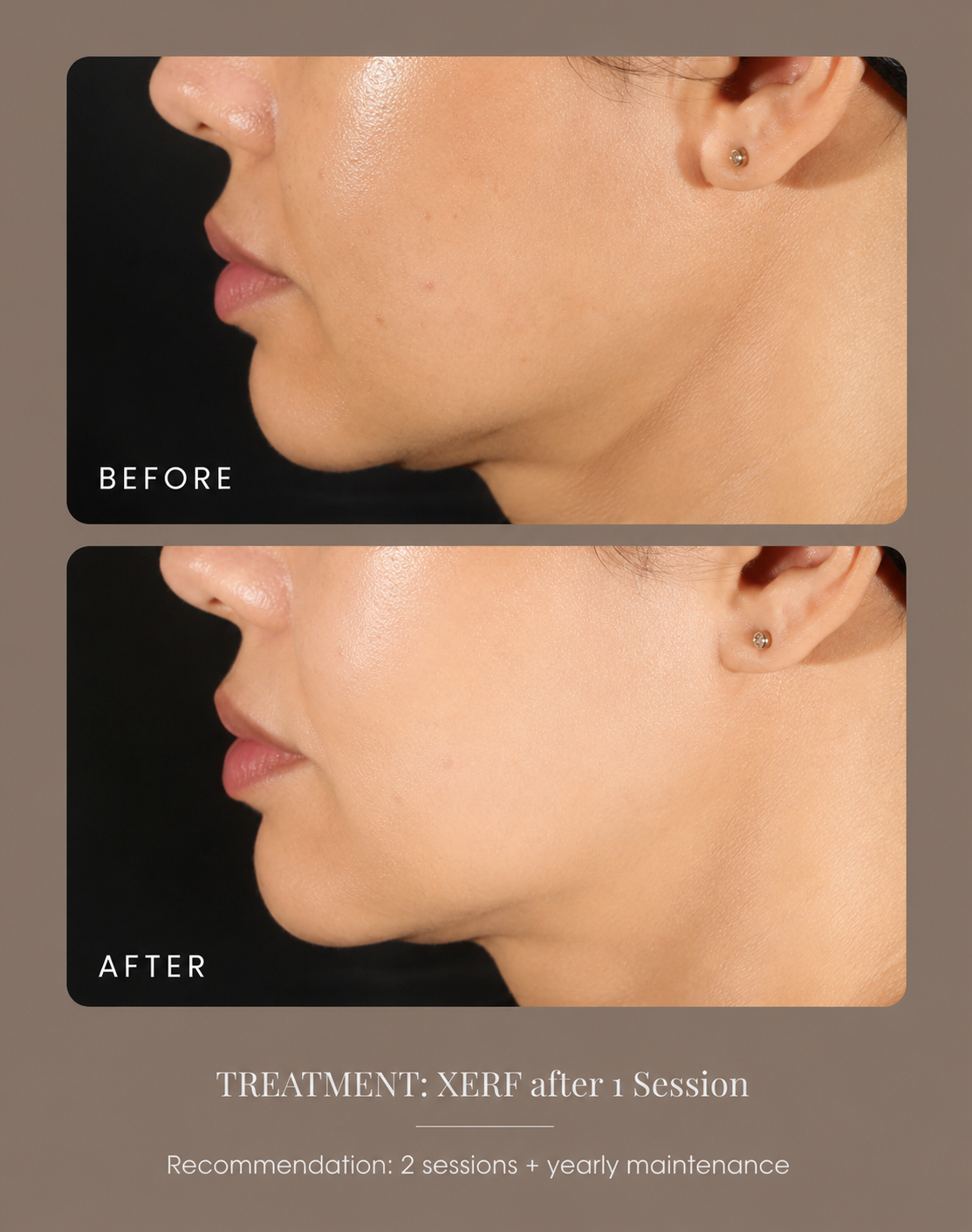 Before and after results from a XERF treatment session