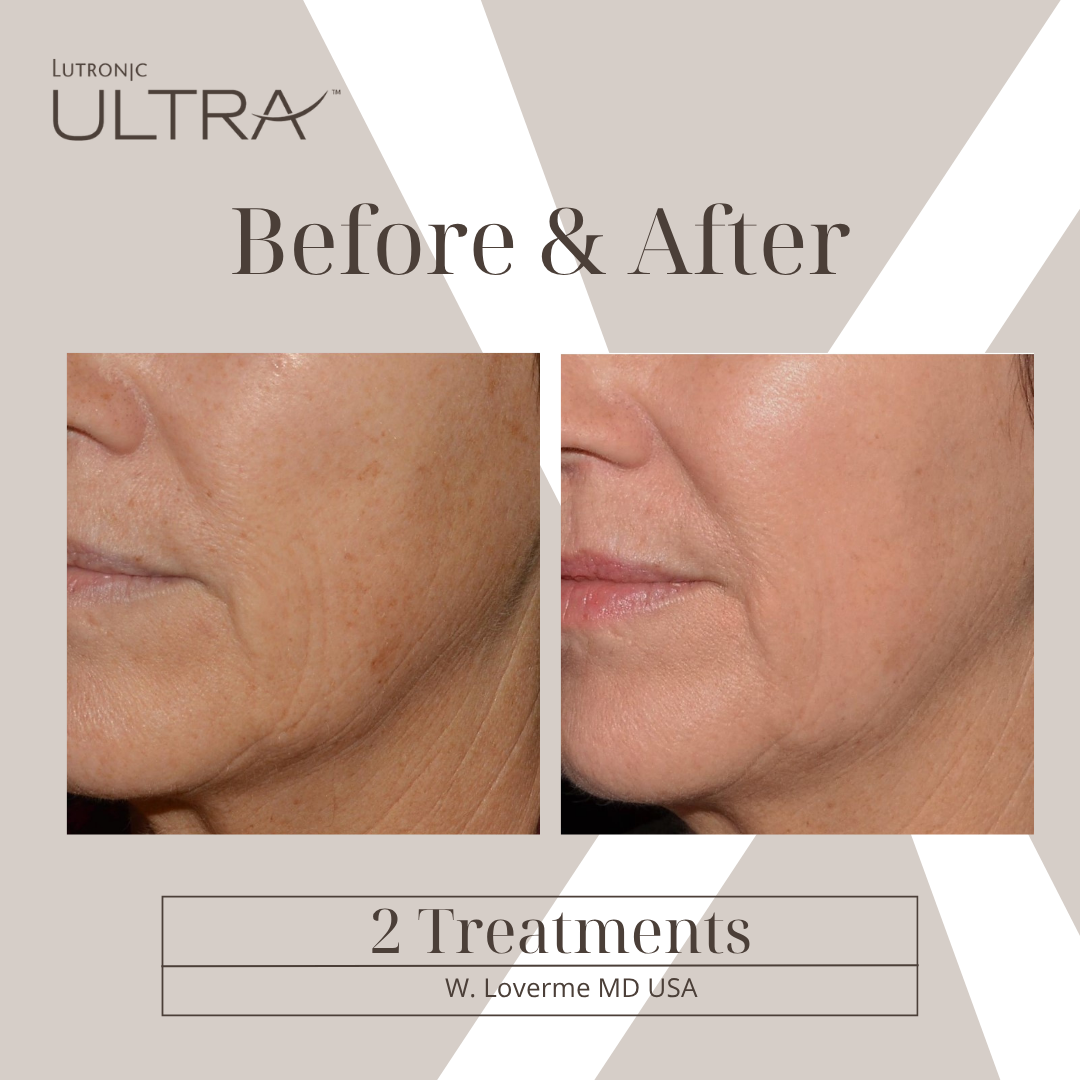 Before & After — ULTRA Skin Resurfacing