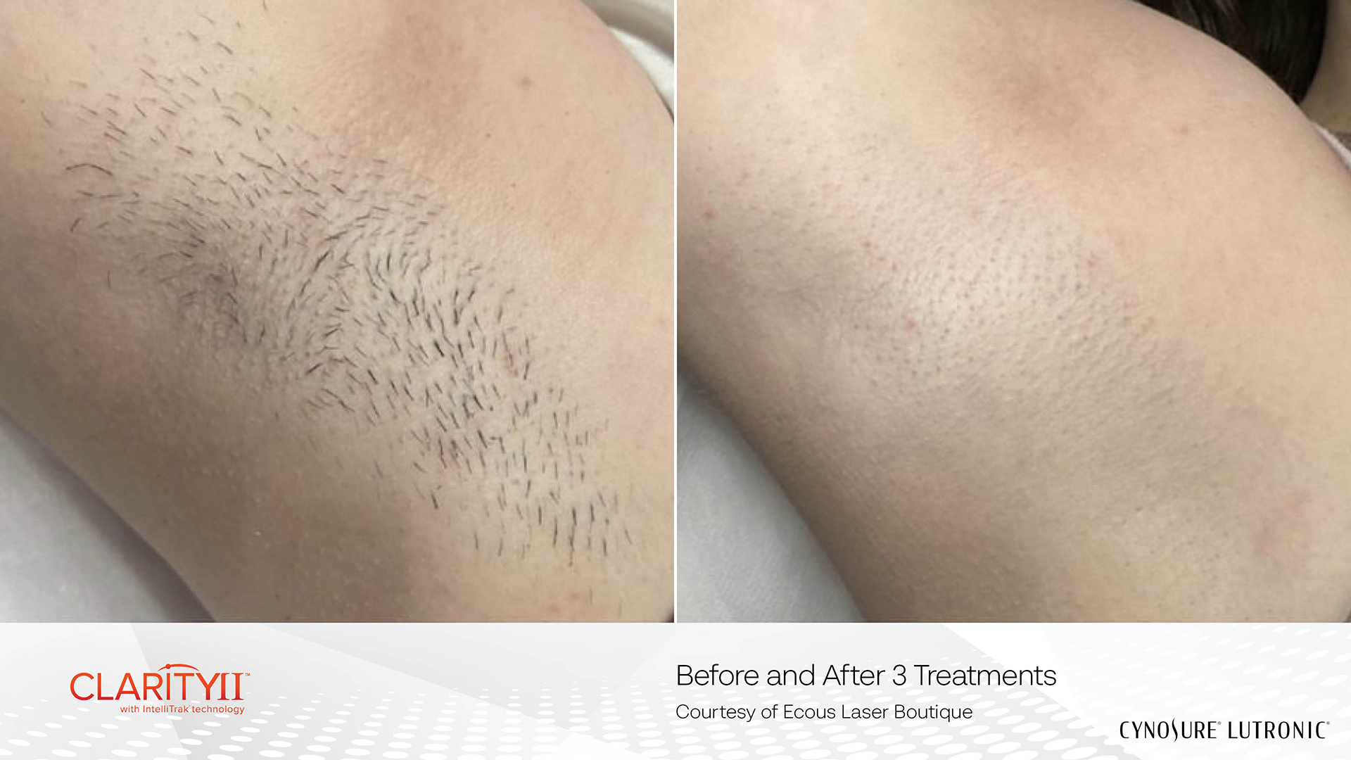 Before & After — Laser Hair Removal