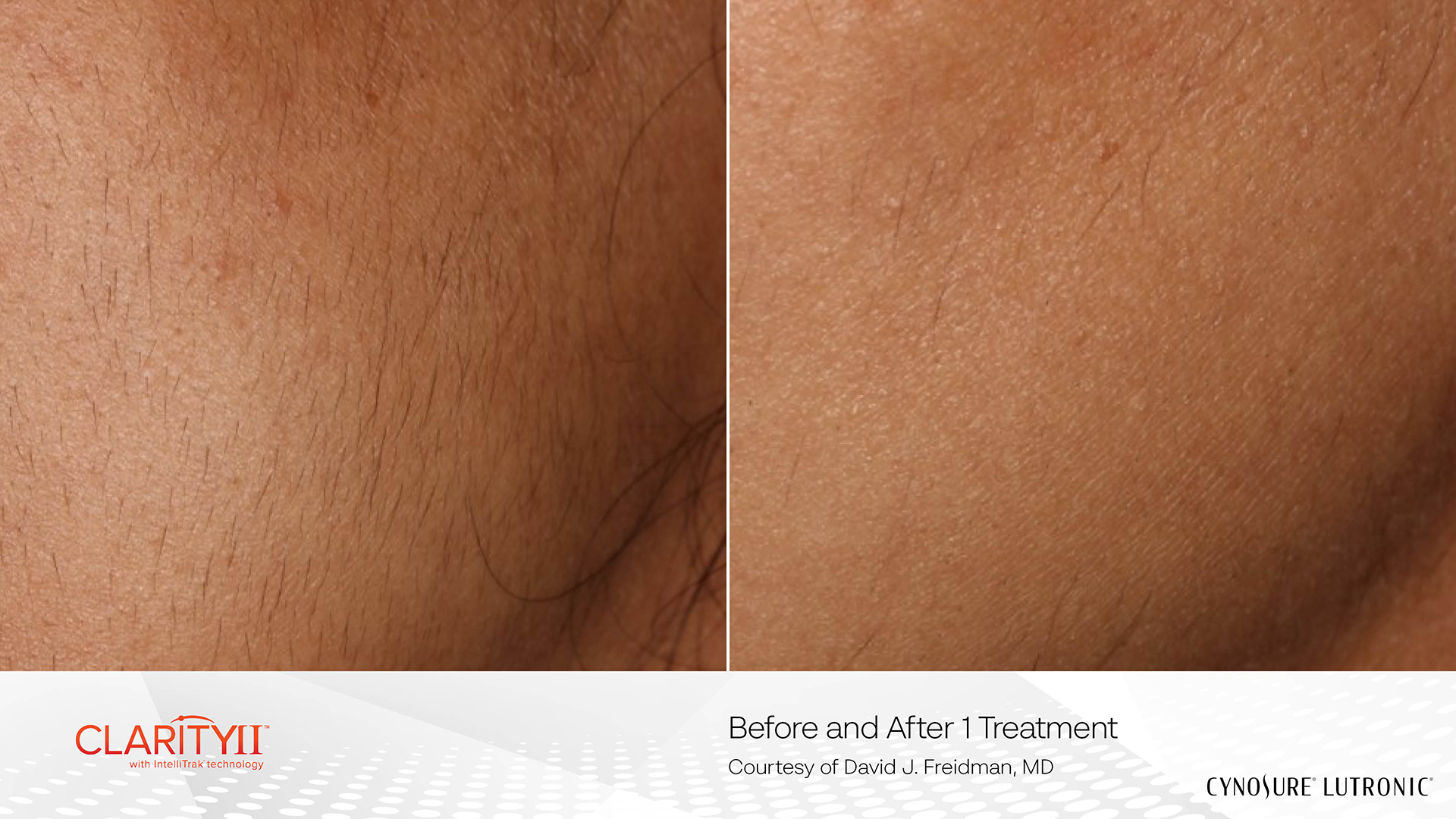 Before & After — Laser Hair Removal