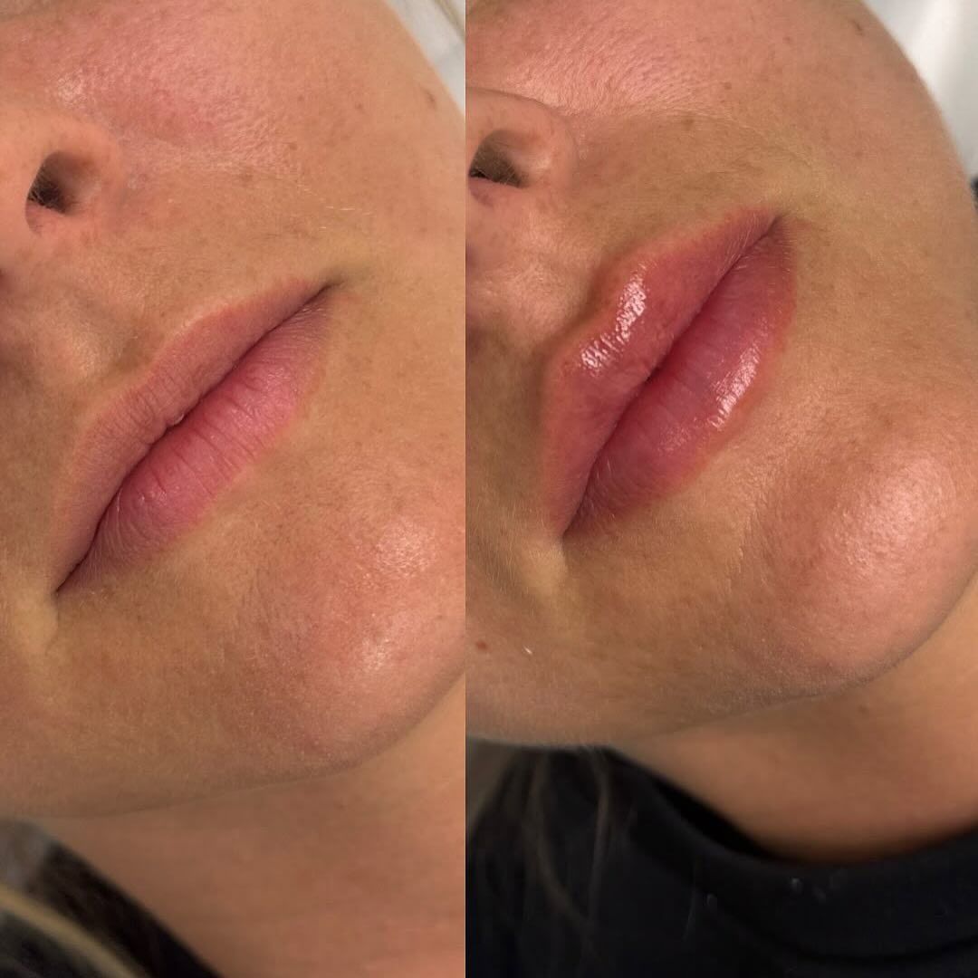 Avant & Après — Filler Dermique aux Lèvres