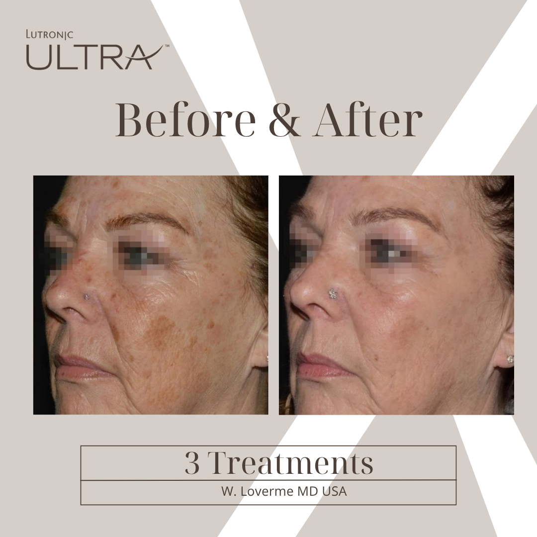 Before & After — ULTRA Skin Resurfacing