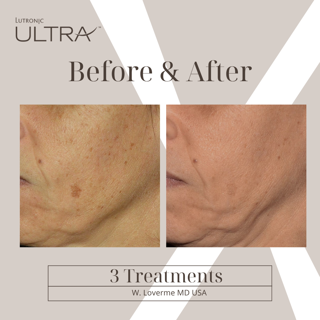 Before & After — ULTRA Skin Resurfacing