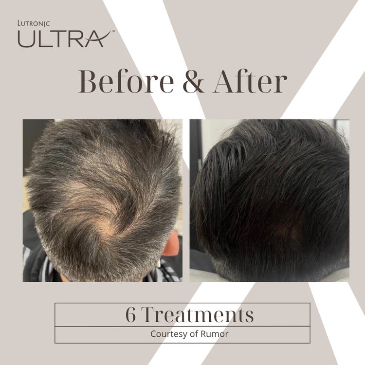 Before & After — ULTRA Hair Restoration