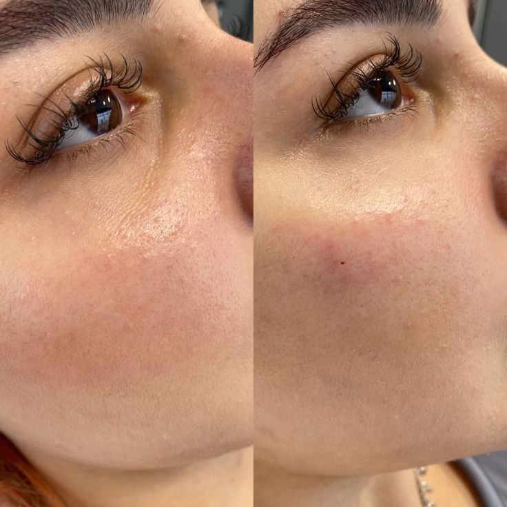 Before & After — NCTF & Quench