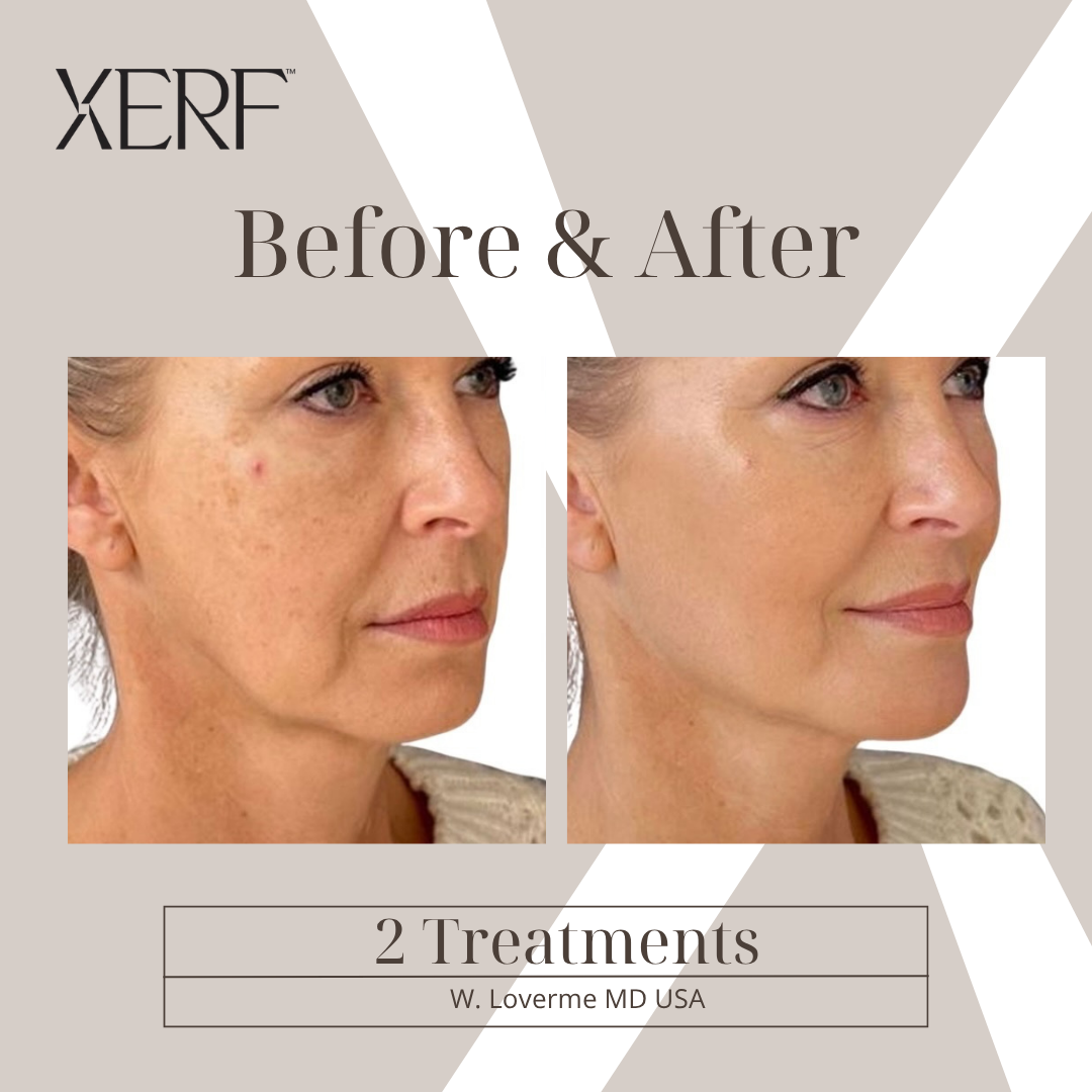 Before & After — XERF