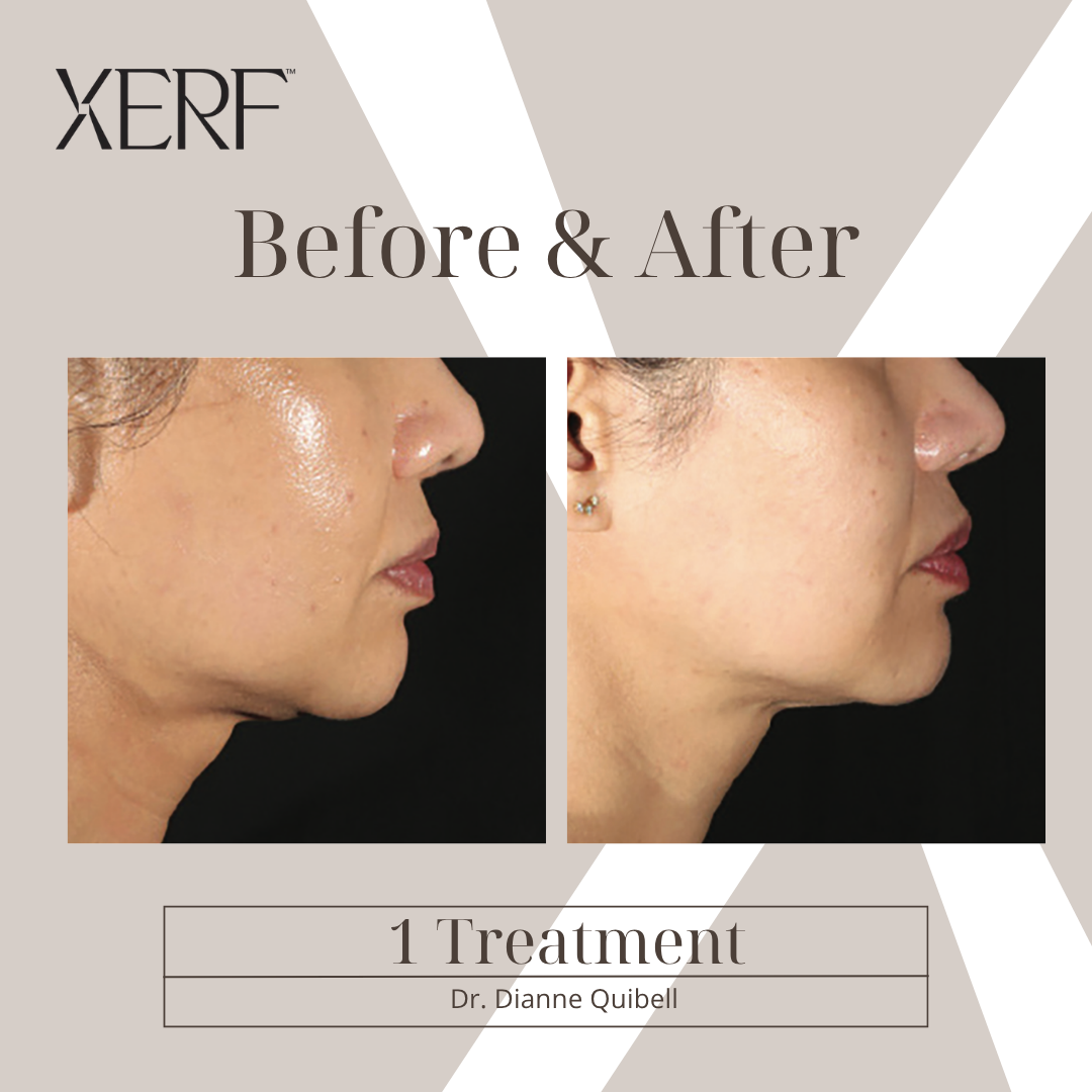 Before & After — XERF